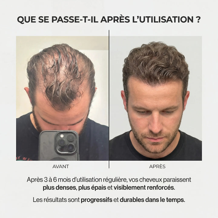 AlphaRoot™ Système de régénération folliculaire