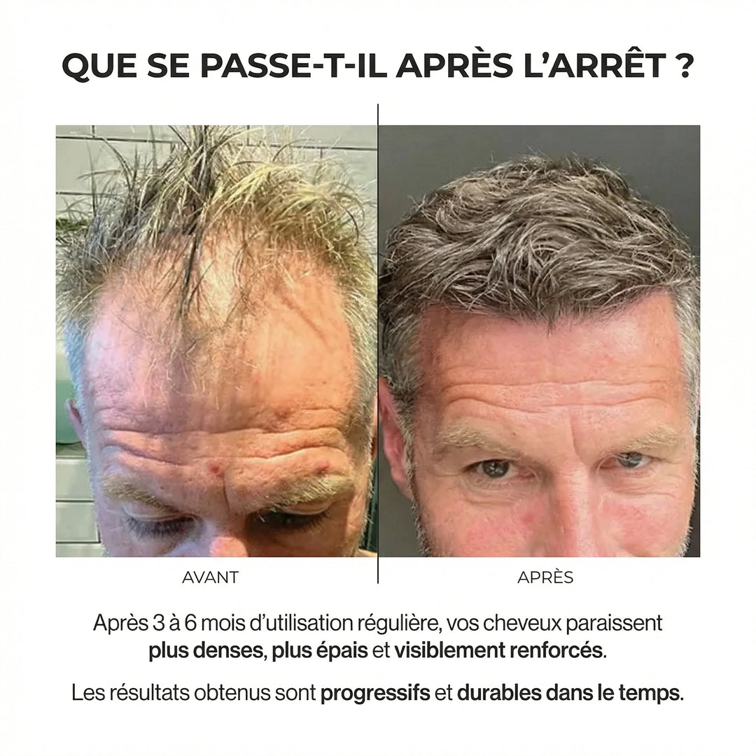 AlphaRoot™ Système de régénération folliculaire